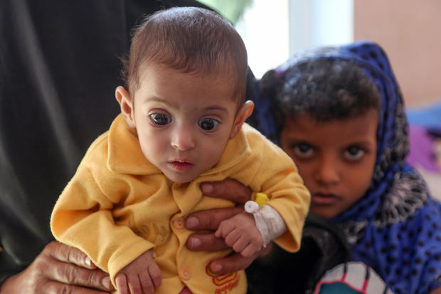 A Yemeni child suffering from malnutrition is seen being held by a woman at a treatment center in a hospital in Taiz on Nov. 21, 2018. 
