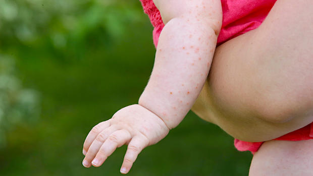 measles - rash 