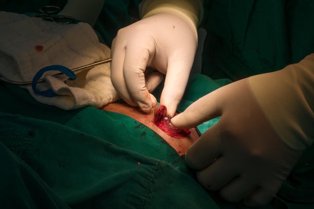 Most expensive medical procedures in the U.S., without