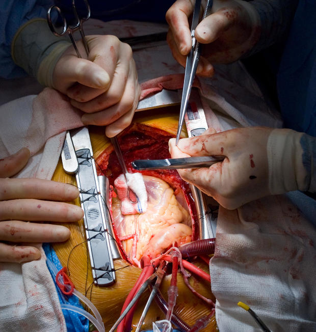 coronary artery bypass surgery cost 