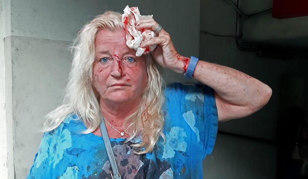 LEBANON-BLAST-WOUNDED
