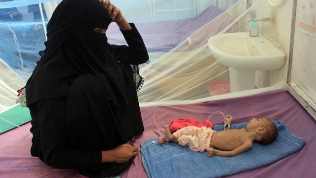 YEMEN-CONFLICT-CHILDREN-HEALTH