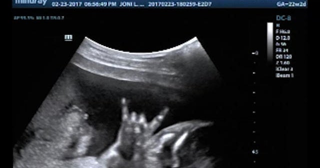 Baby flashes rock on sign during ultrasound