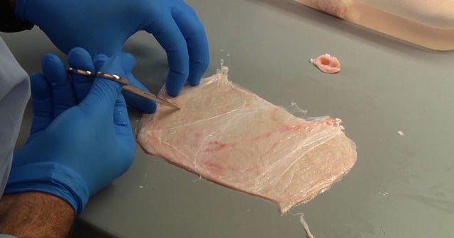 Patients regrow muscles with help from pig tissue