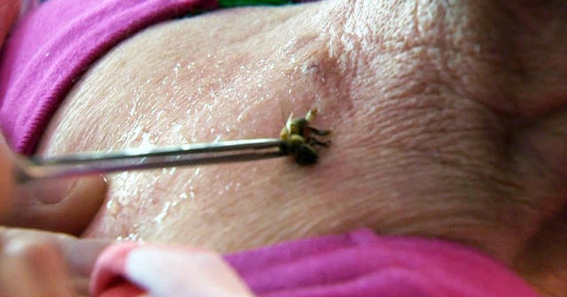Are bee stings the solution to chronic pain?