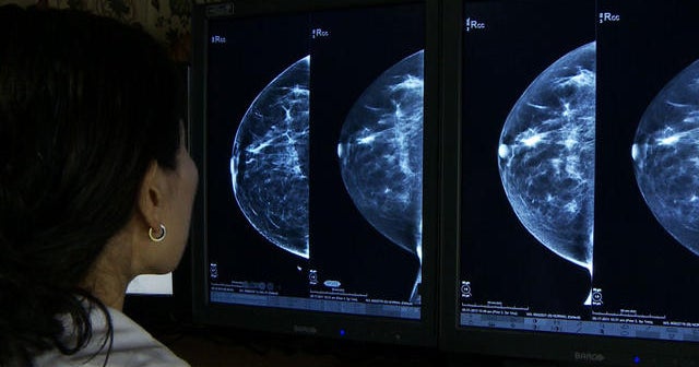 3D mammograms enhance cancer screening, study says