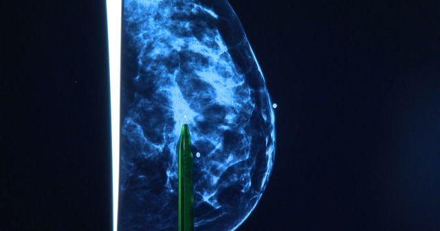 Scientists develop new classifications for breast cancer