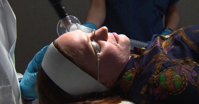 New laser technology for acne scar treatment
