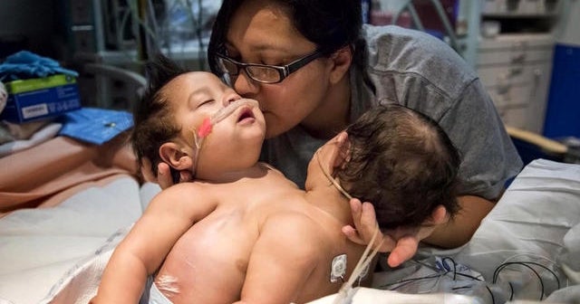 Conjoined twin girls get ready for separation