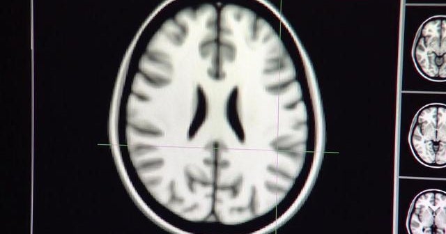 Heavy teen marijuana use may cause memory problems