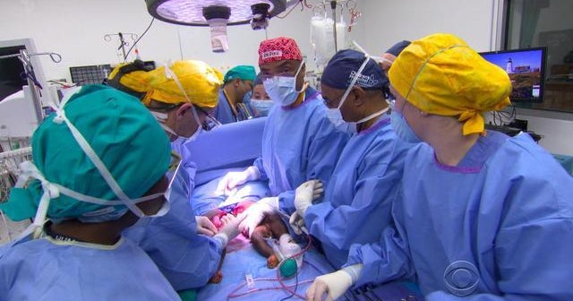 Conjoined twins separated in Haiti