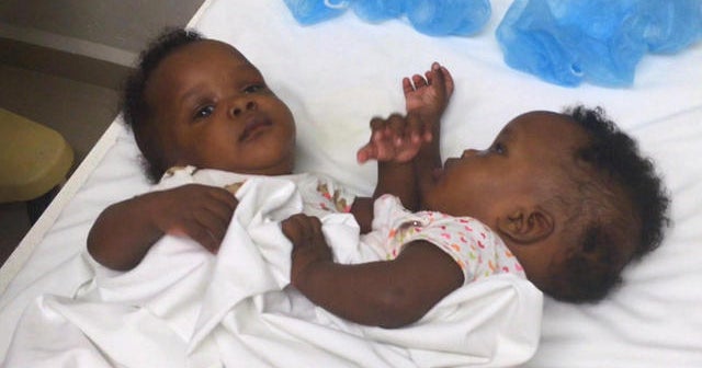 Haitian conjoined twins get help from a native son