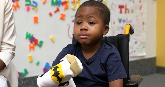 Meet Zion, the first child to get a double hand transplant