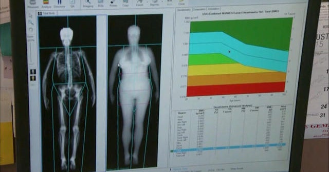 Fat scanner reveals hidden risks