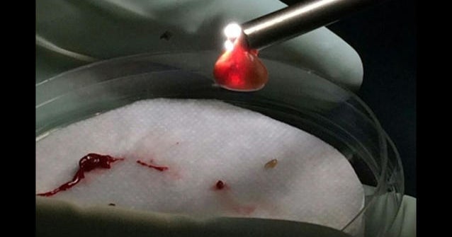 California man survives parasite in brain