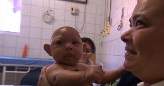 Investigating link between Zika and birth defects