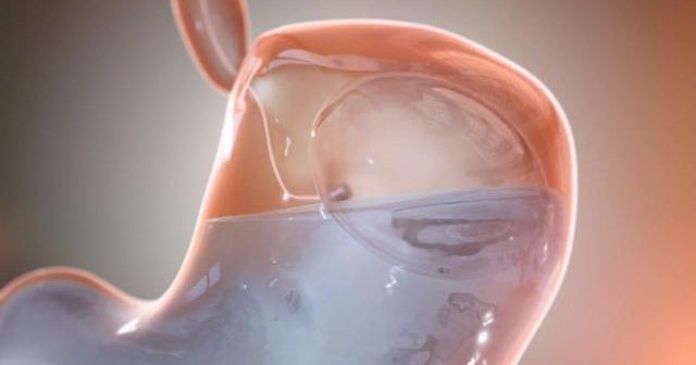 New balloon capsule could take bite out of obesity