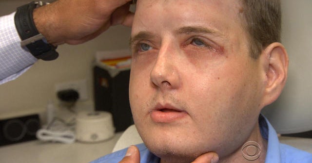 Face transplant recipient thriving one year after surgery