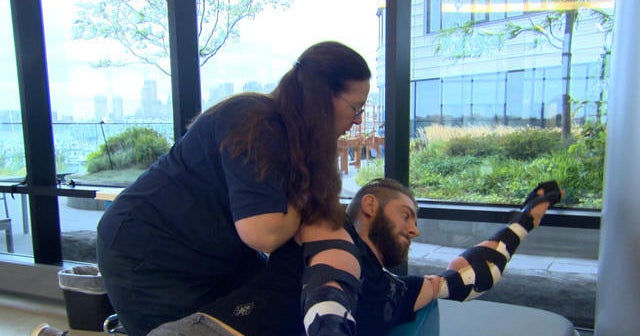 Marine vet adjusts to double arm transplant