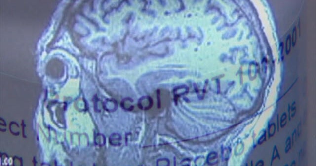 Drug being tested for Lewy body dementia