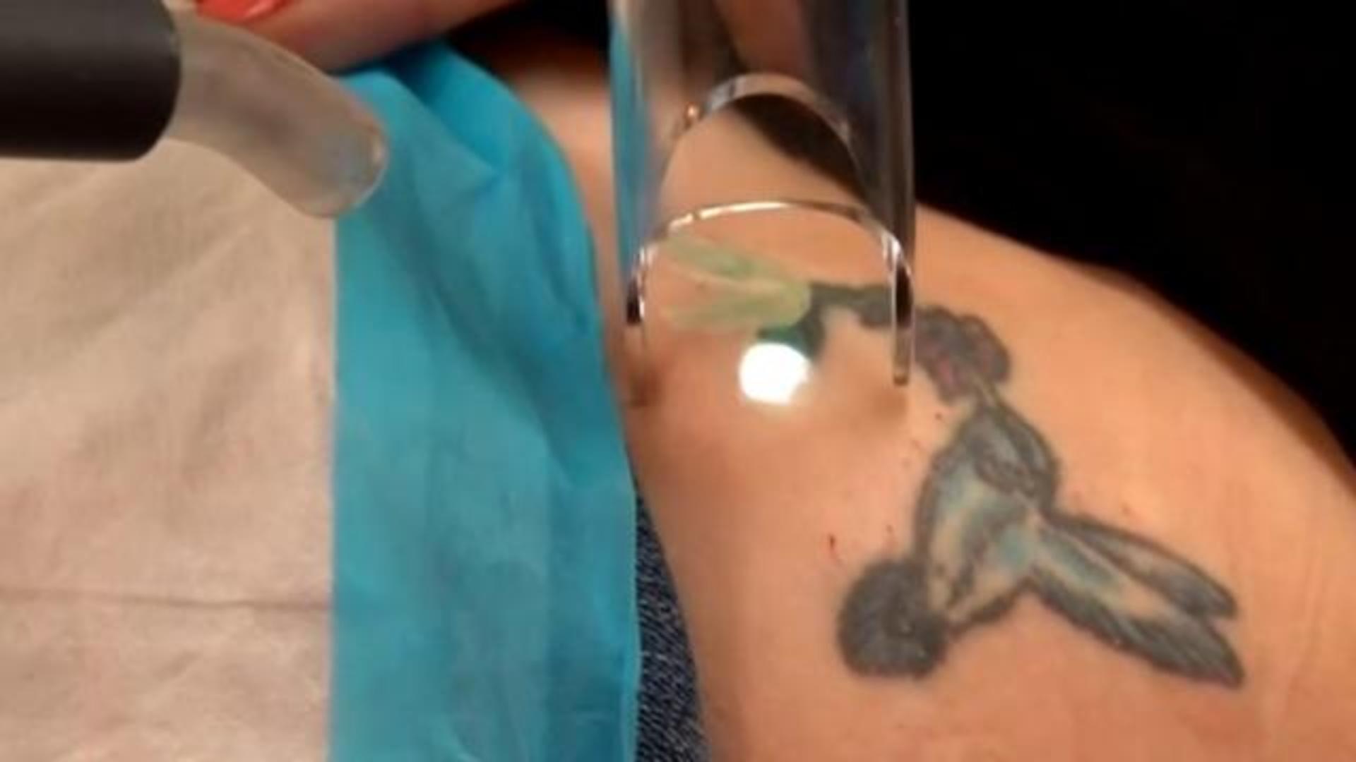 Tattoo removal procedures spike post-pandemic - CBS News