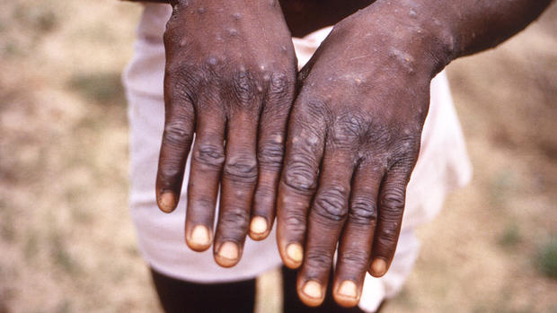 Monkeypox Lesions 