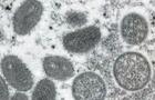 cbsn-fusion-more-monkeypox-cases-reported-in-us-thumbnail-1026561-640x360.jpg 